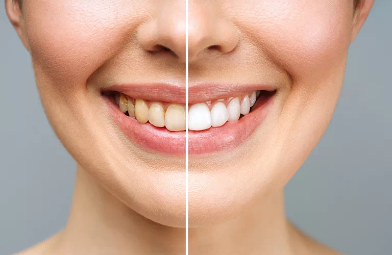 porównanie zębów przed i po wybielaniu